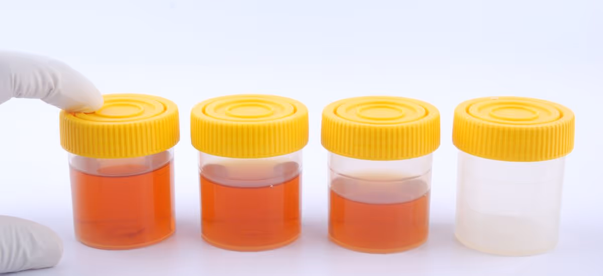 Blood in the Urine Banner 4