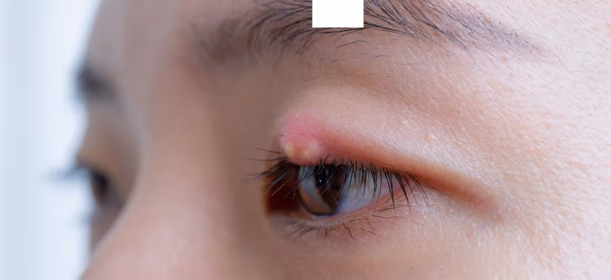 Blepharitis