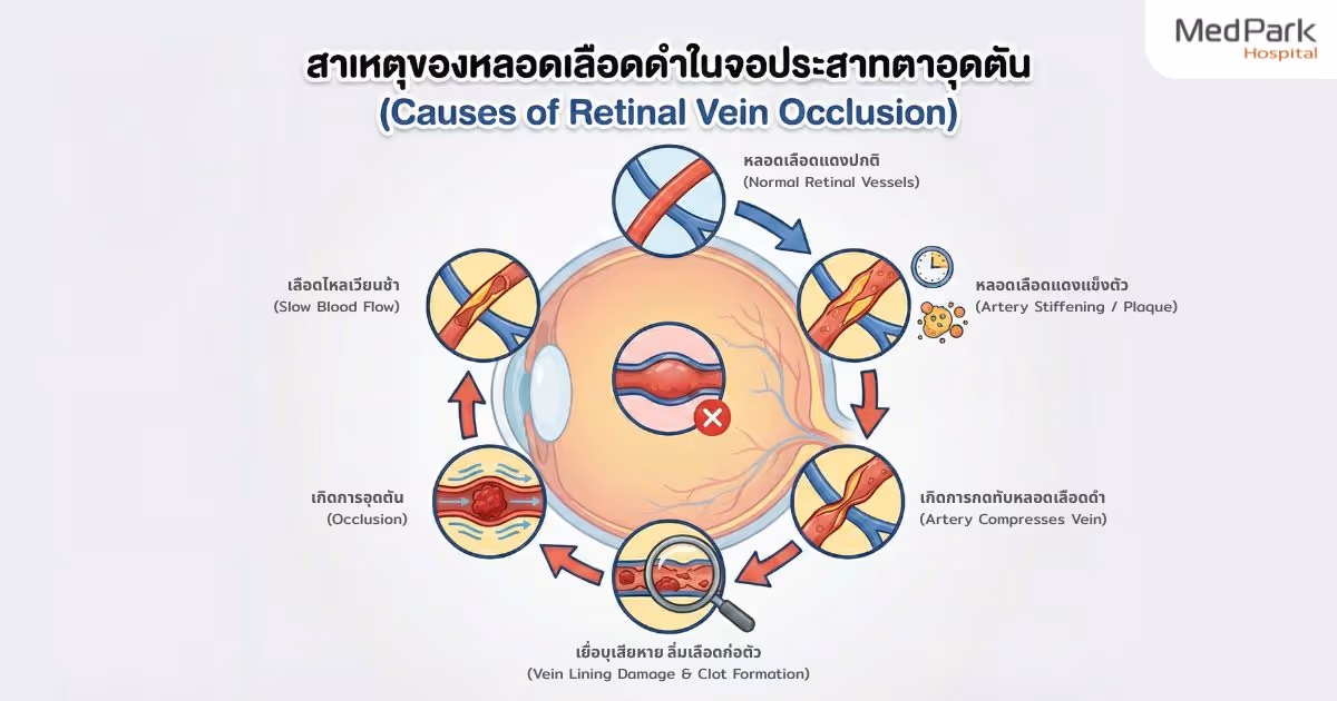 Retinal Vein Occlusion (rvo)   Infographic