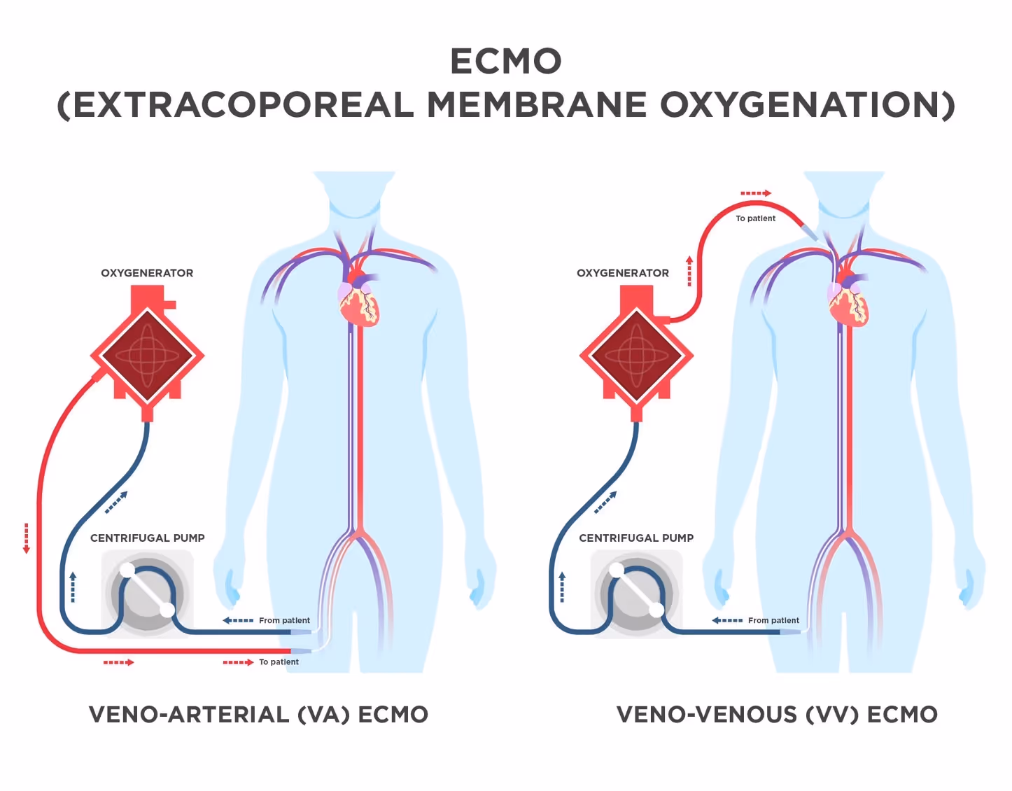 What is an ECMO procedure?