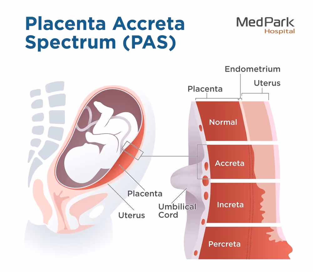 Precenta Accreta Spectrum; placenta accreta, placenta increta, placenta percreta, placenta previa