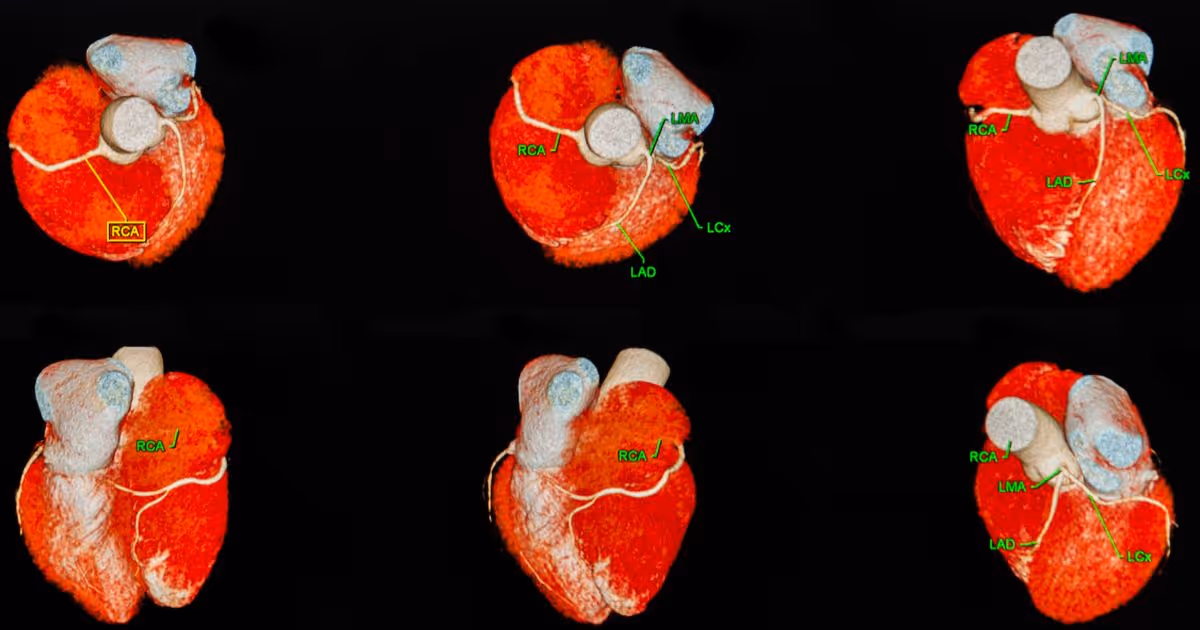 CT scan calcium score indicates coronary artery disease risk