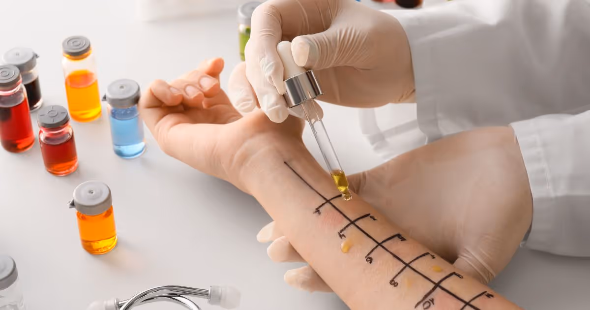 Skin Prick Test procedure