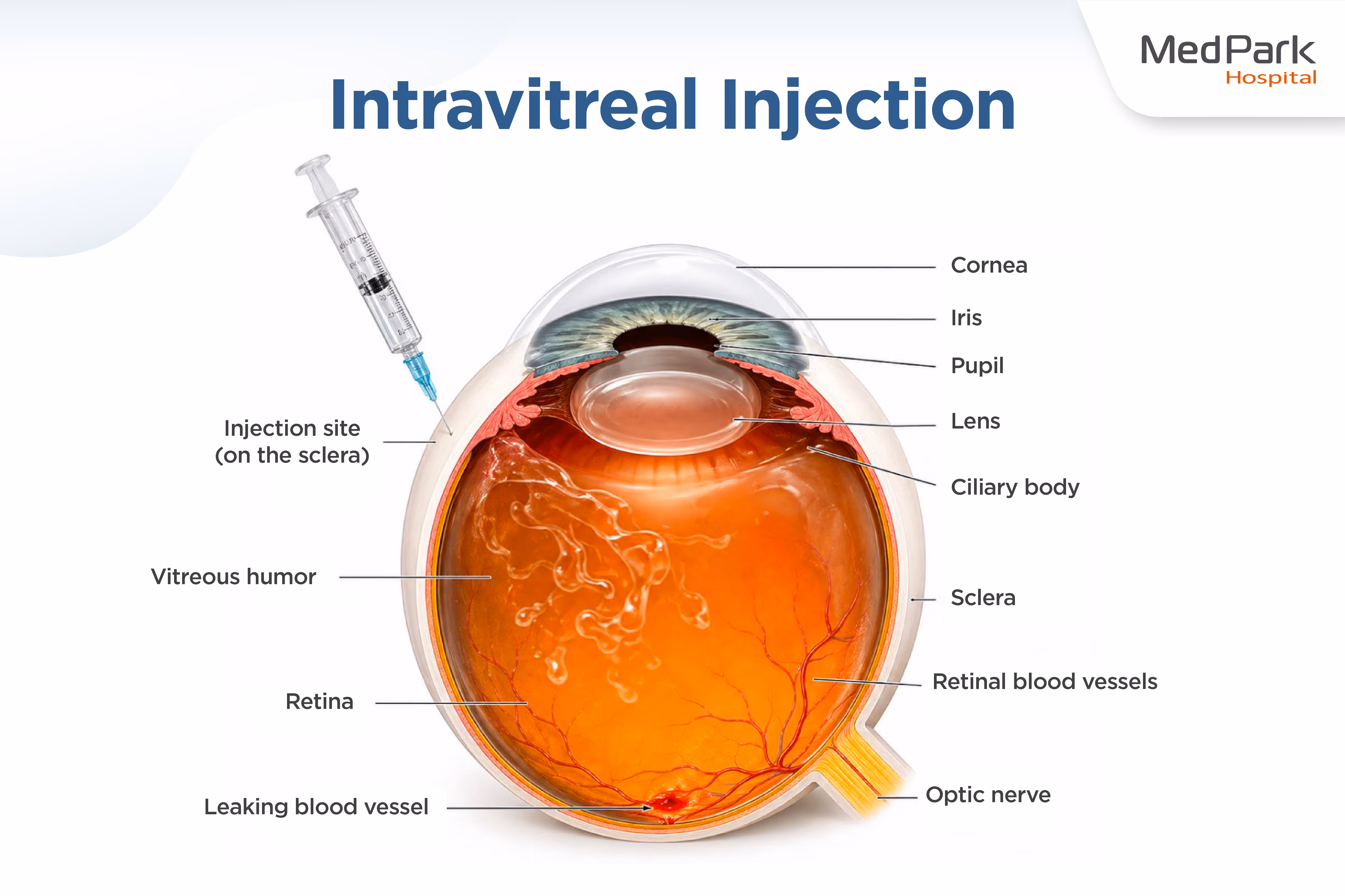 การฉีดยาเข้าวุ้นตา (intravitreal Injection) En
