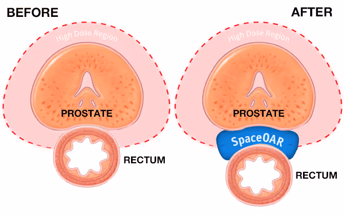 Benefits of utilizing SPACEOAR Vue Hydrogel in conjunction with radiotherapy 