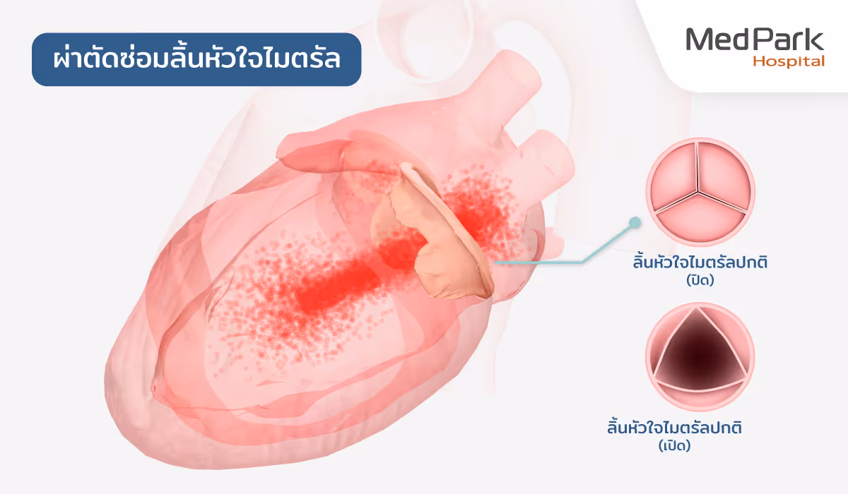 What Is the Mitral Valve Repair Procedure