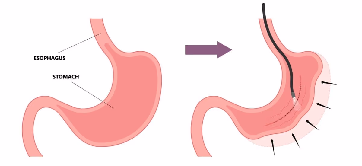 รูปการส่องกล้องเย็บกระเพาะอาหารเพื่อลดน้ำหนัก (Endoscopic sleeve gastroplasty: LSG)