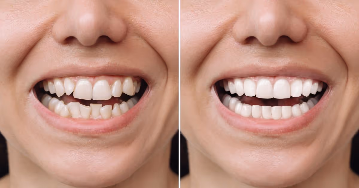 Invisalign Banner 3