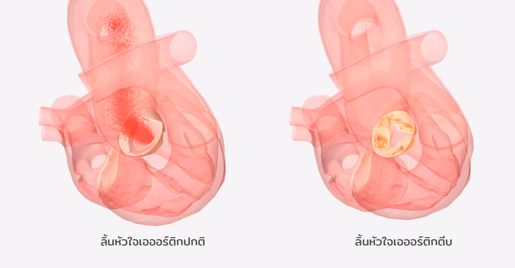 เปลี่ยนลิ้นหัวใจ ไม่ต้องผ่าตัด TAVI (Transcatheter aortic valve implantation)