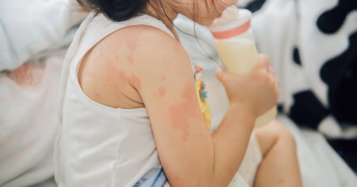 Understanding Food Allergy Banner 1