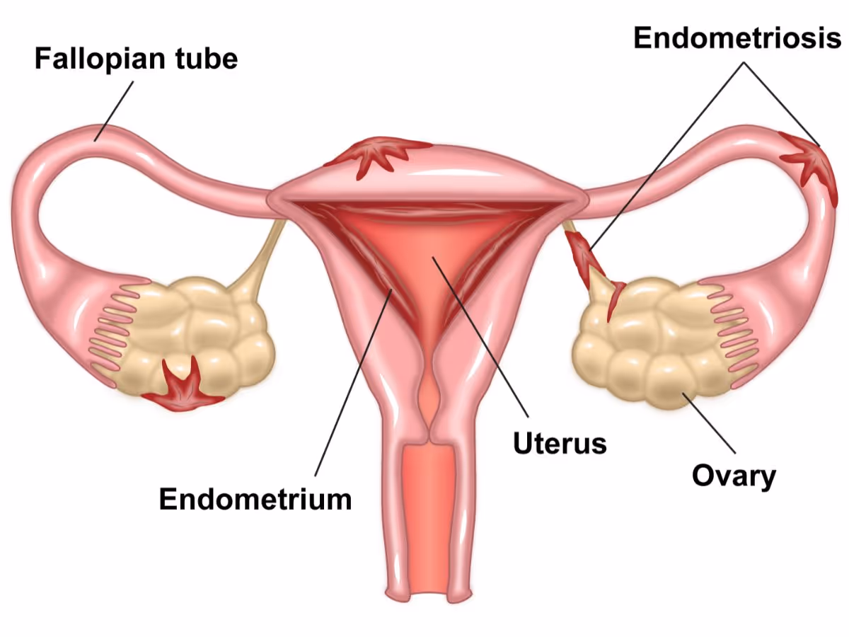  เนื้อเยื่อที่บุอยู่ภายในมดลูก อยู่ส่วนไหนของร่างกาย - Era Test