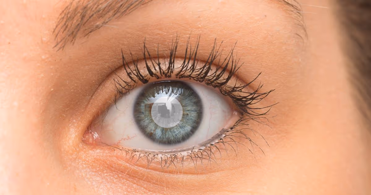 ต้อกระจก (Cataract) เกิดจากอะไร อาการ การรักษา - Cataract: Causes, Symptoms, Treatments, Early signs