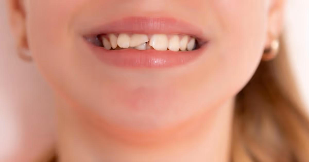 Dental Crown Banner 7
