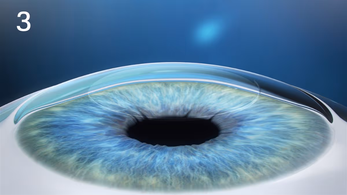 Lasik Smile Pro 3