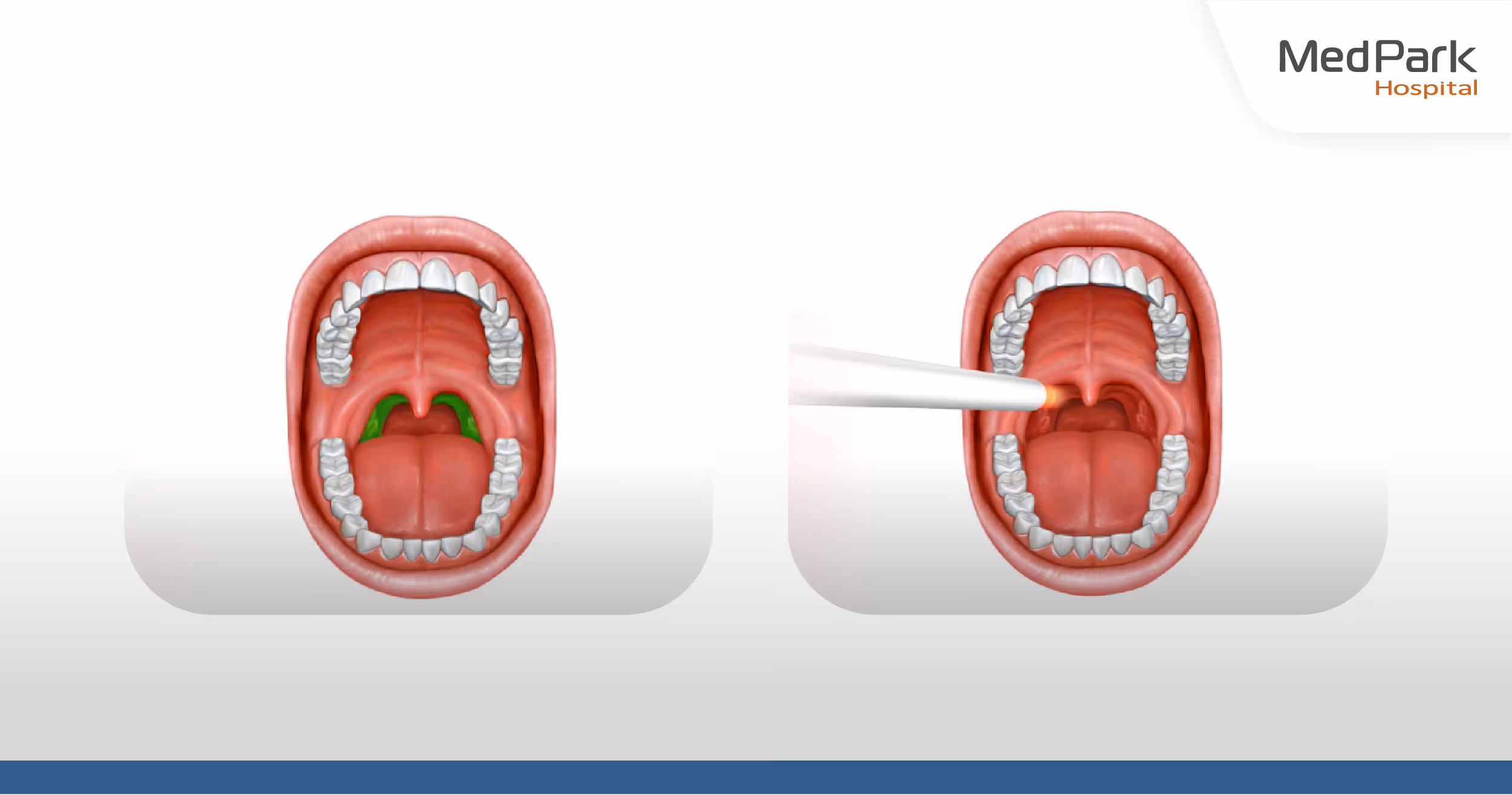 Post-operative NightLase laser snoring treatment