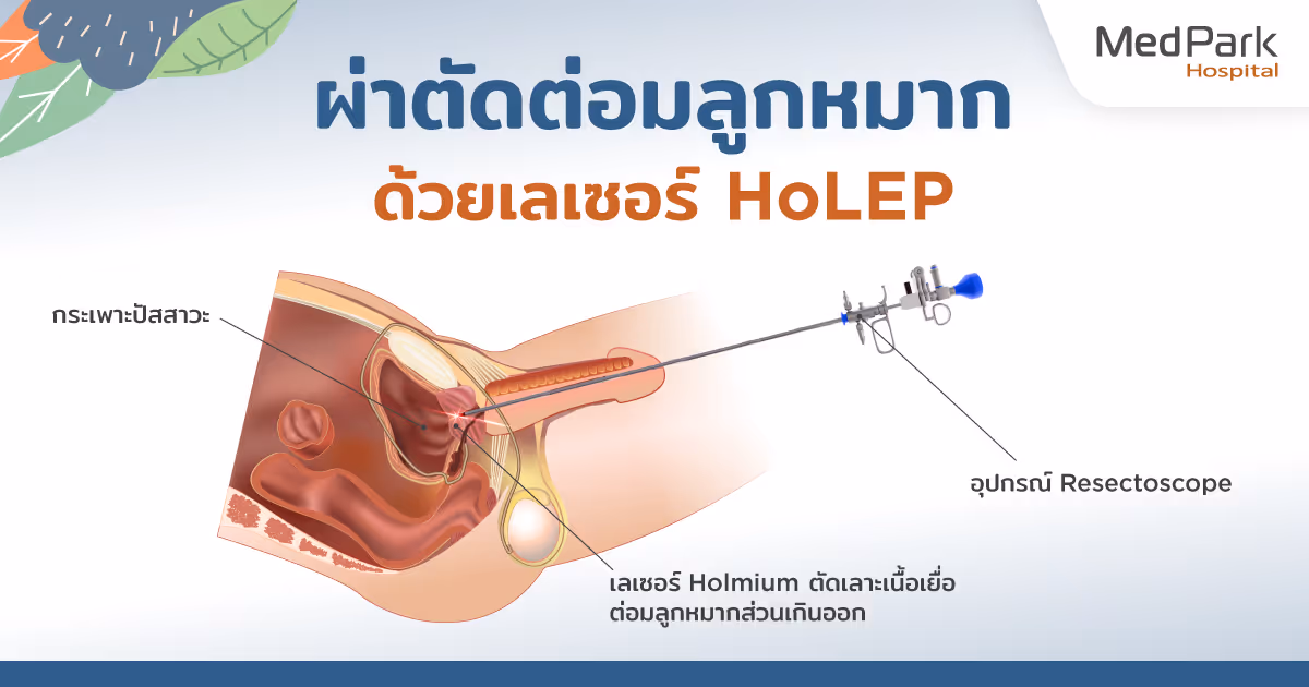 ขั้นตอนการผ่าตัดต่อมลูกหมากด้วยเลเซอร์ HoLEP