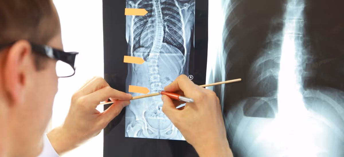 How Is Scoliosis Diagnosed