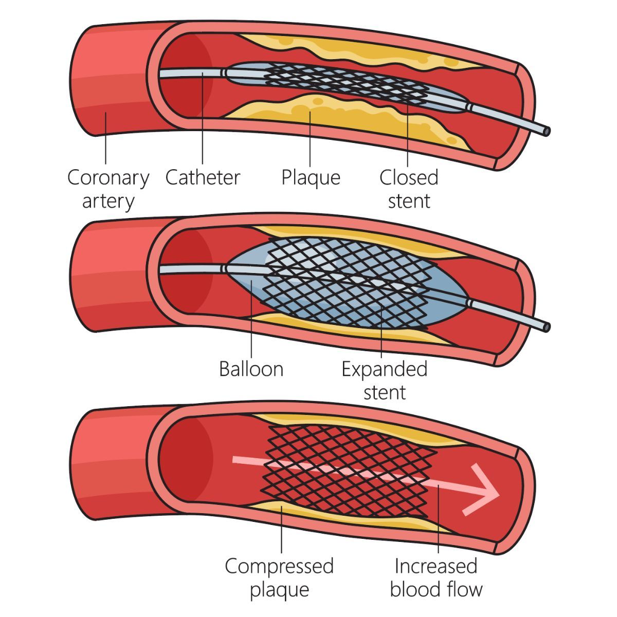 instructions about the preparatory steps before the PCI procedure