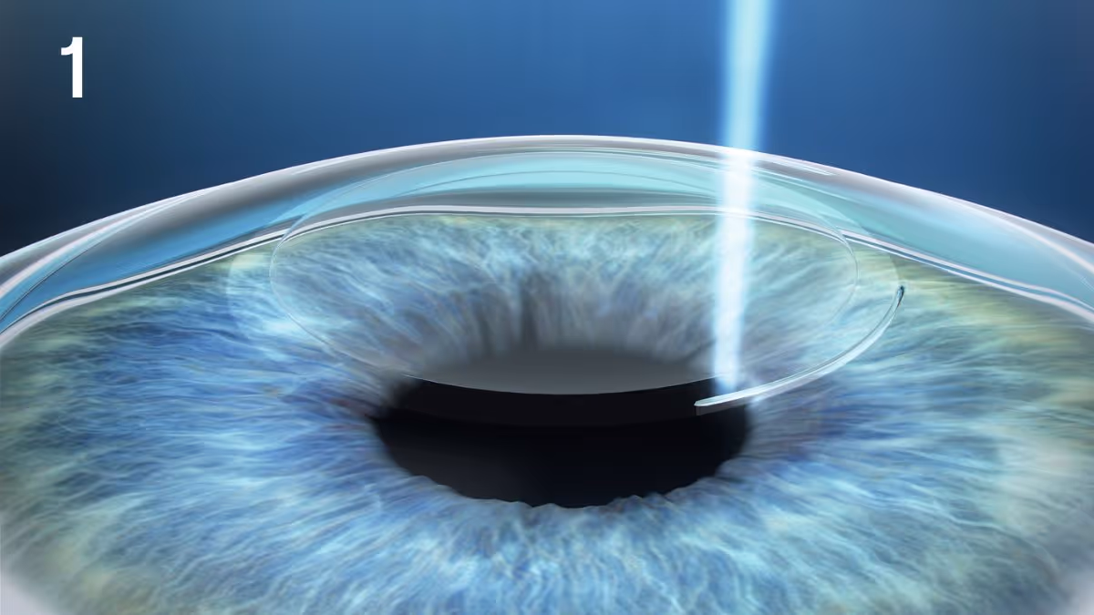 Lasik Smile Pro 1