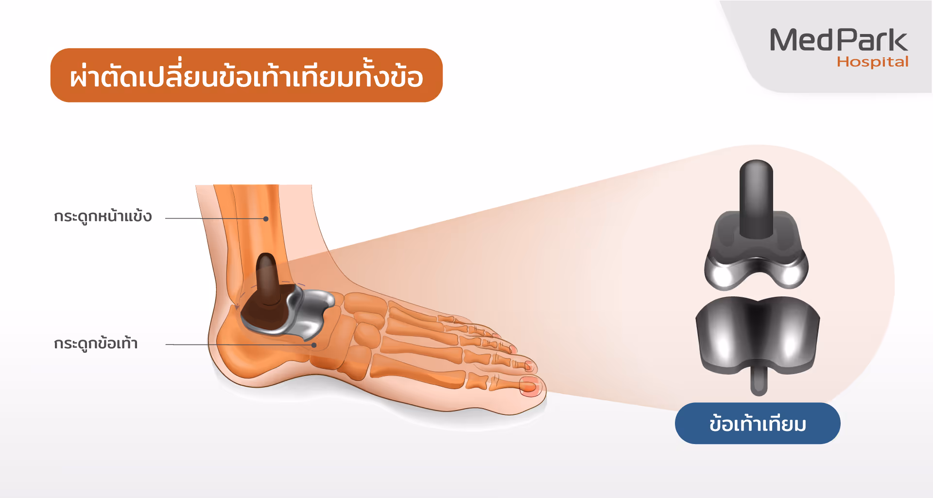 ขั้นตอนการผ่าตัดเปลี่ยนข้อเท้าเทียมทั้งข้อ