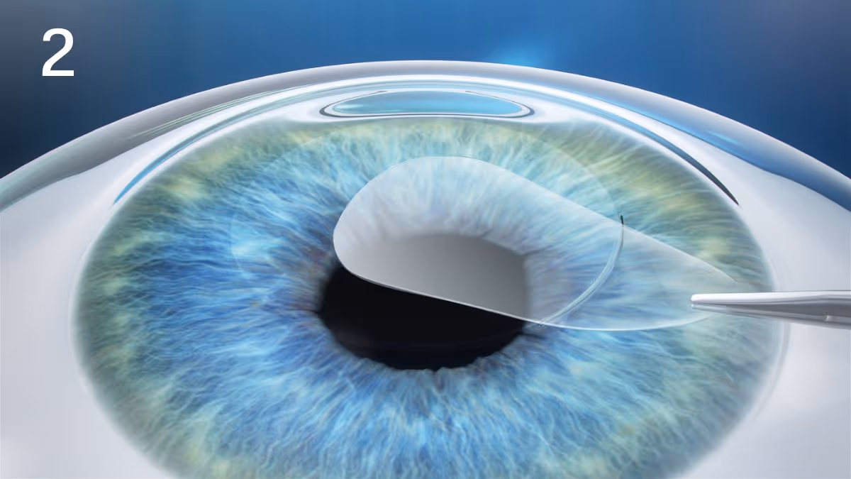 Lasik Smile Pro 2