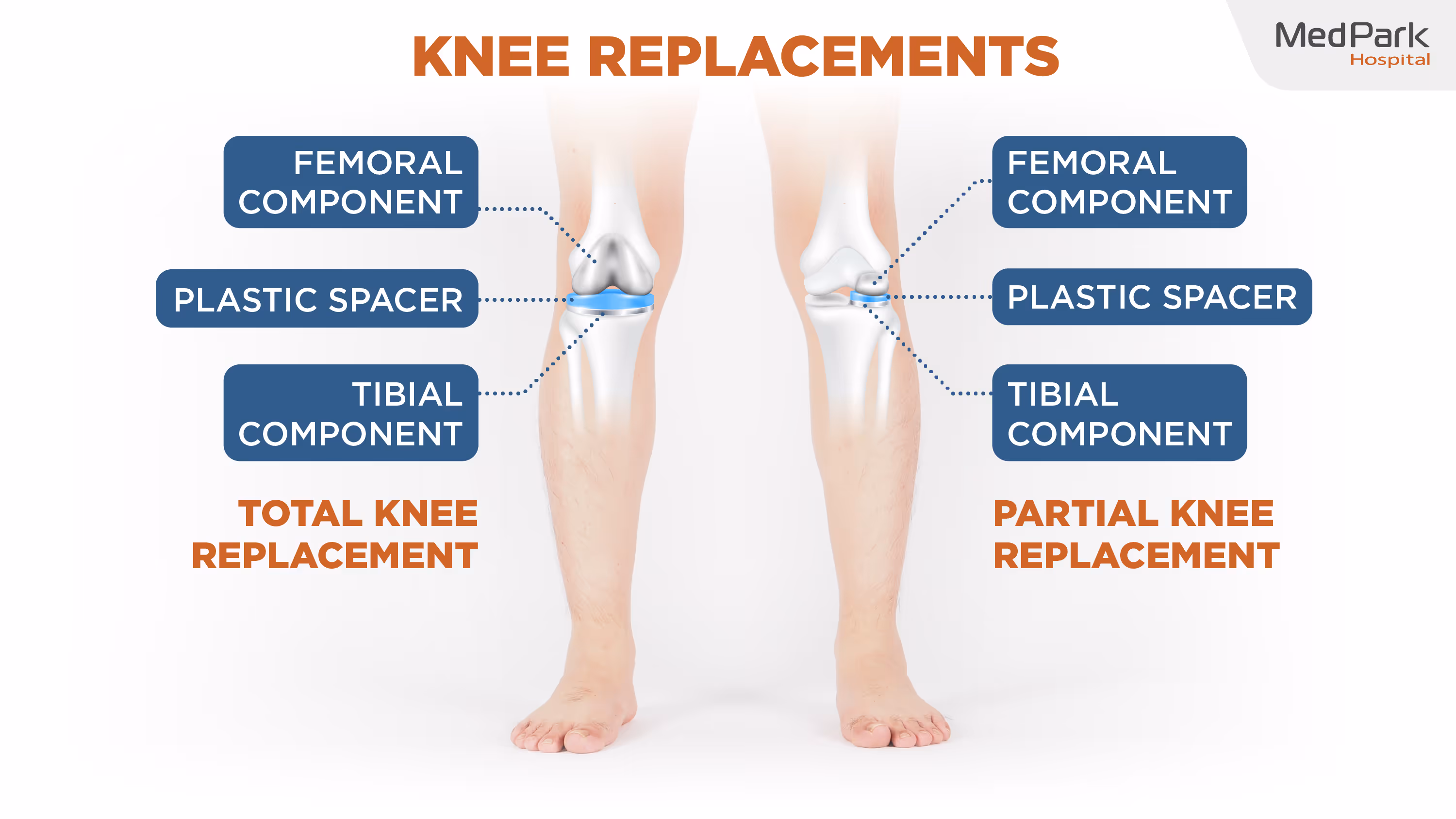 Total knee Replacement procedure