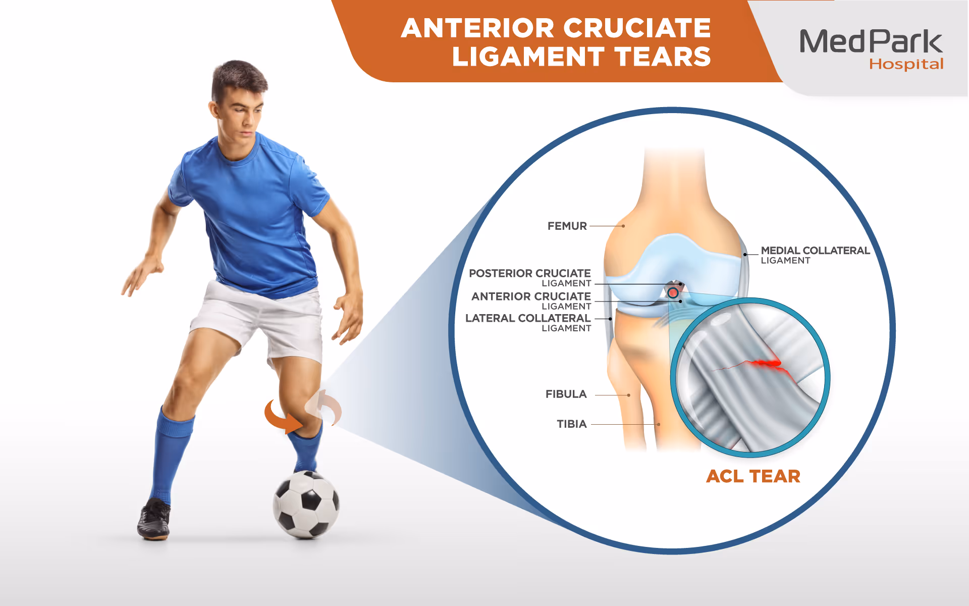 What conditions does ACL reconstruction treat?