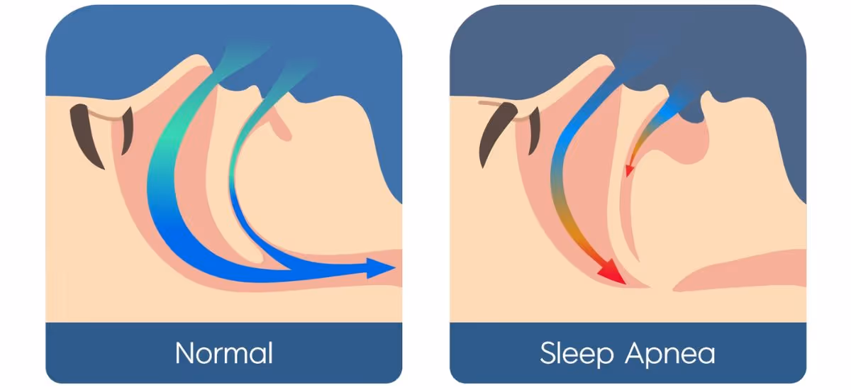 sleep apnea