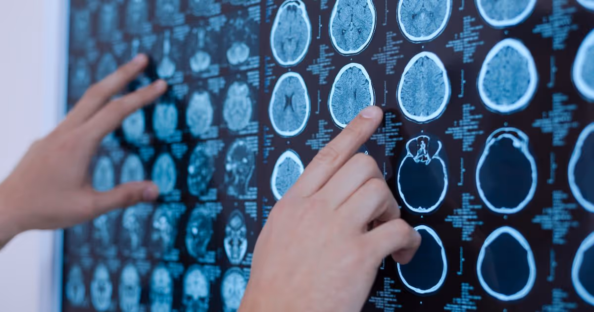 Brain MRI: What can a brain MRI visualize?