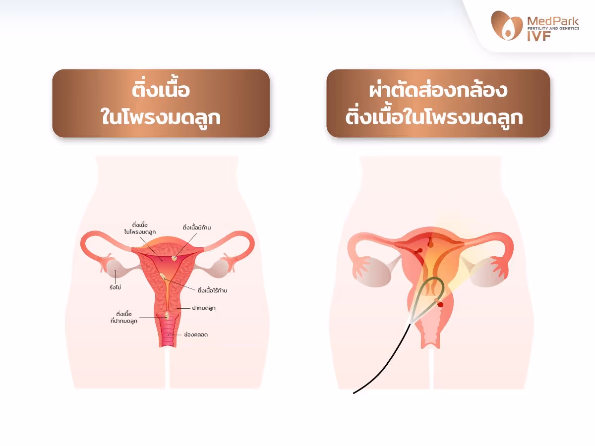 ภาพแสดงการส่องกล้องตรวจโพรงมดลูก หาติ่งเนื้อในโพรงมดลูก