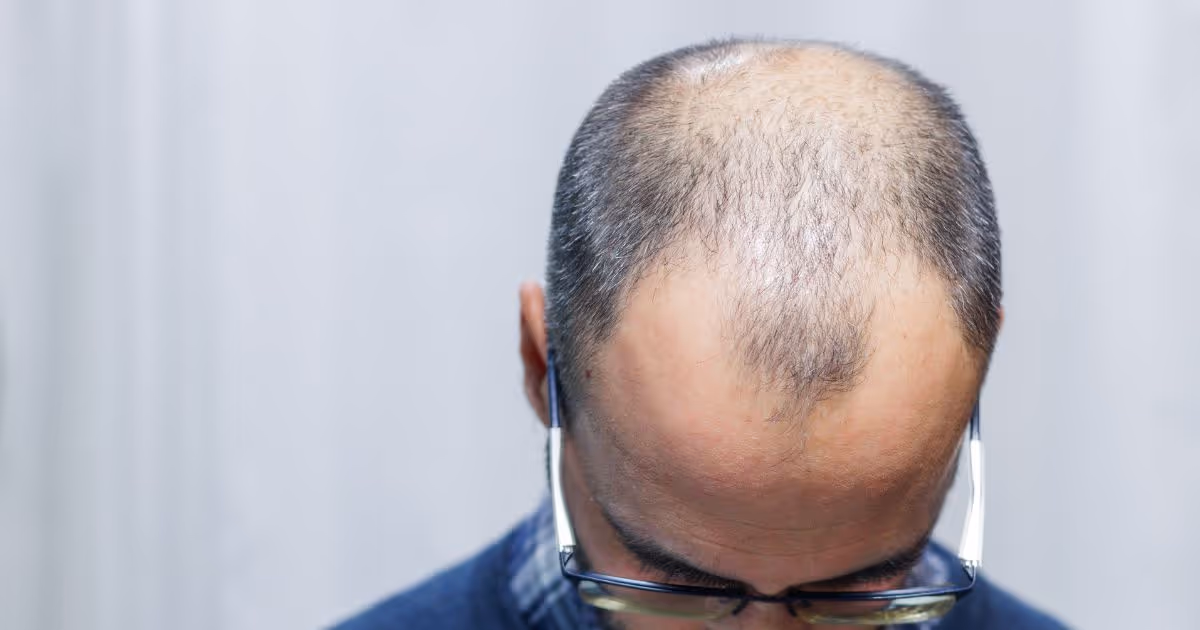 Hair Restoration Surgery