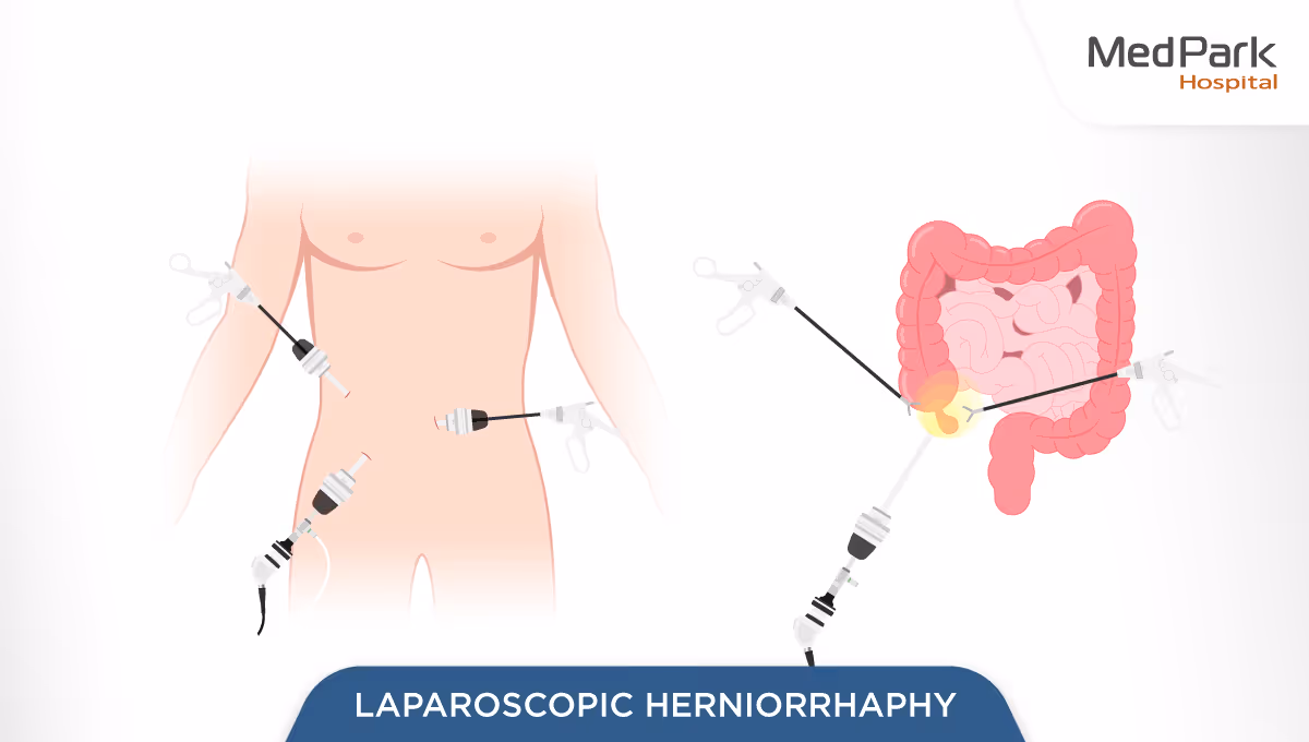 Aw Laparoscopic Herniorrhaphy 2 En