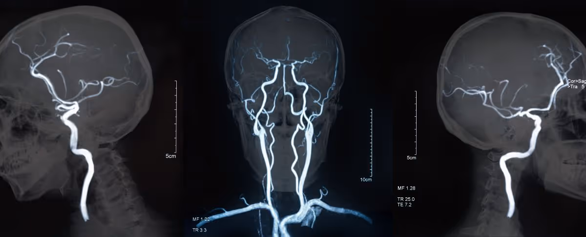 How does MRA differ from Computed Tomographic Angiography (CTA)?