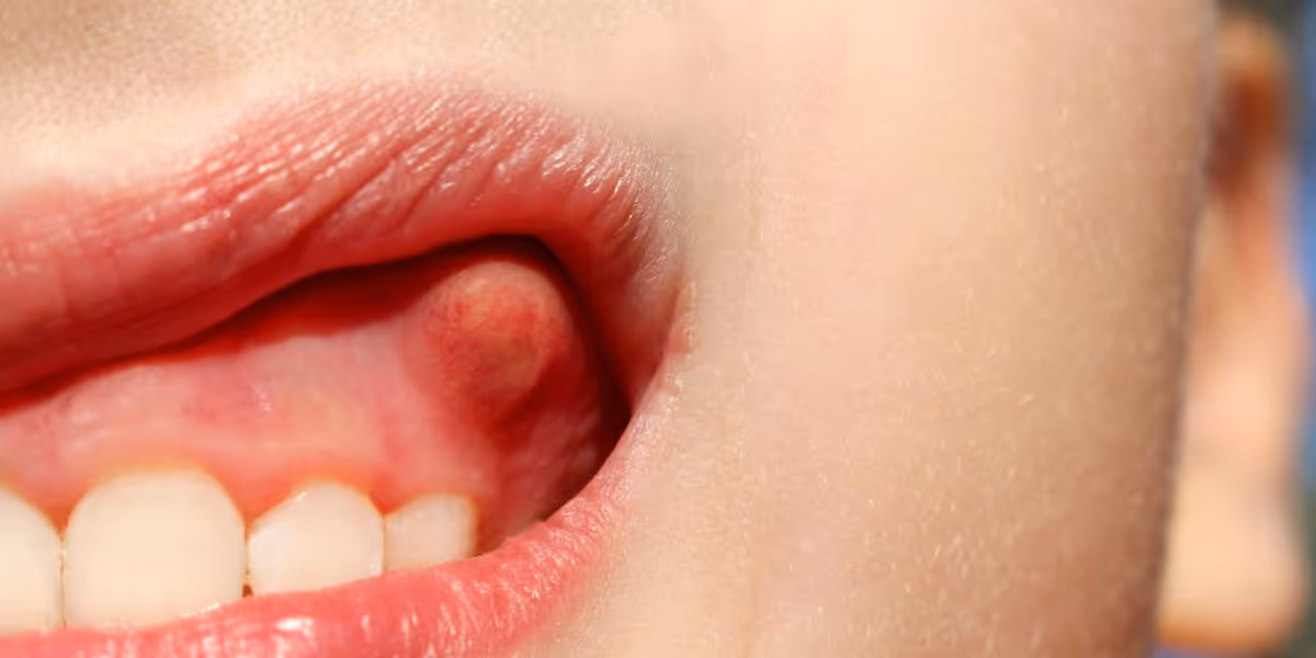 Mouth abscesses: Abscesses can form around the teeth, gums, and throat. If an abscess forms around the tooth, it is called a tooth abscess or tooth abscess.