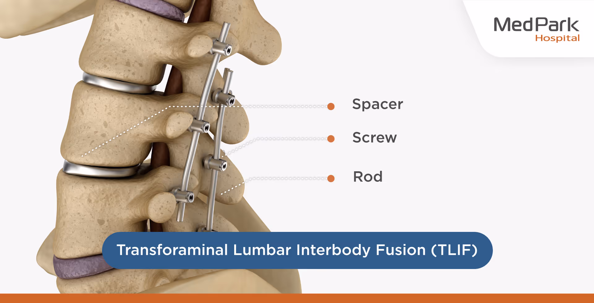 ขั้นตอนการผ่าตัดเชื่อมข้อกระดูกสันหลังส่วนเอว TLIF - the TLIF surgery procedure
