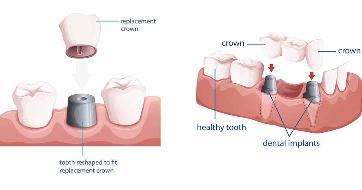 Procedure for making dental implants-ขั้นตอนการทำรากฟันเทียม