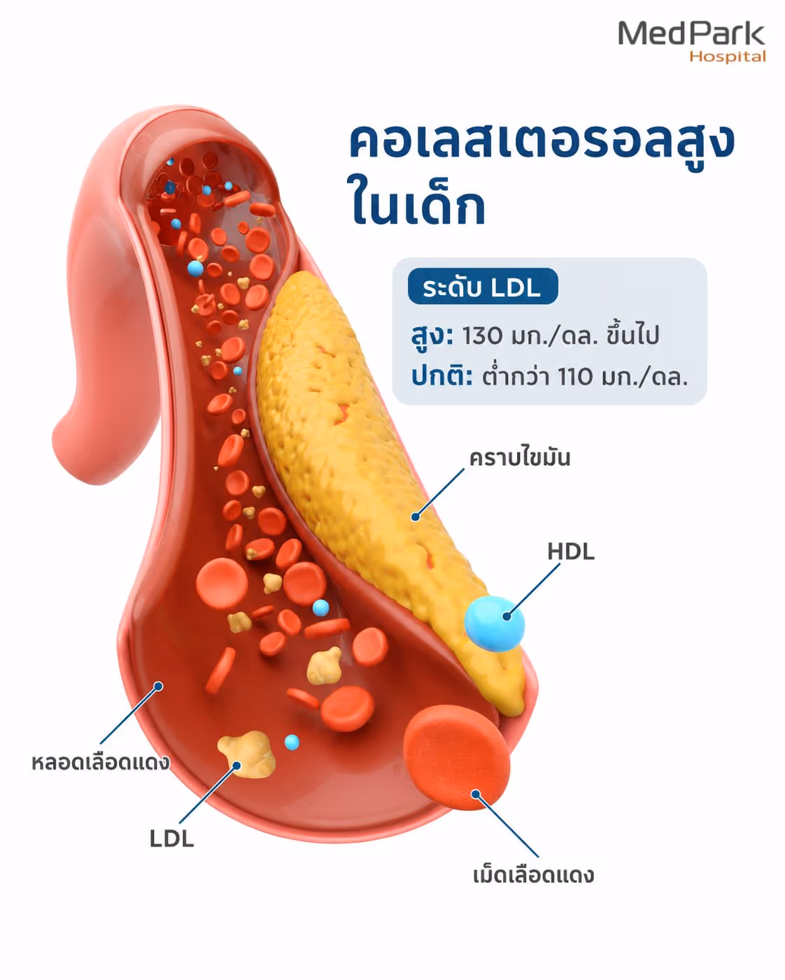 ภาพประกอบตัดขวางหลอดเลือดแดง แสดงภาวะคอเลสเตอรอลสูงในเด็ก มีไขมันสะสม (Fatty Plaque) สีเหลืองเกาะตามผนังหลอดเลือดจนตีบแคบ ภายในมีเม็ดเลือดแดง, LDL (กลุ่มสีเหลือง), และ HDL (วงกลมสีฟ้า) ไหลผ่าน พร้อมกล่องข้อความแสดงระดับ LDL: สูง คือ 130 mg/dL ขึ้นไป, ปกติ คือ ต่ำกว่า 110 mg/dL จัดทำโดยโรงพยาบาลเมดพาร์ค