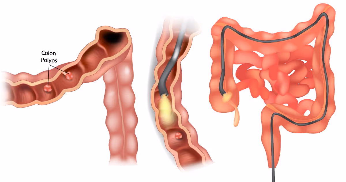 ขั้นตอนการส่องกล้องลำไส้ใหญ่ - What is the procedure for a colonoscopy?