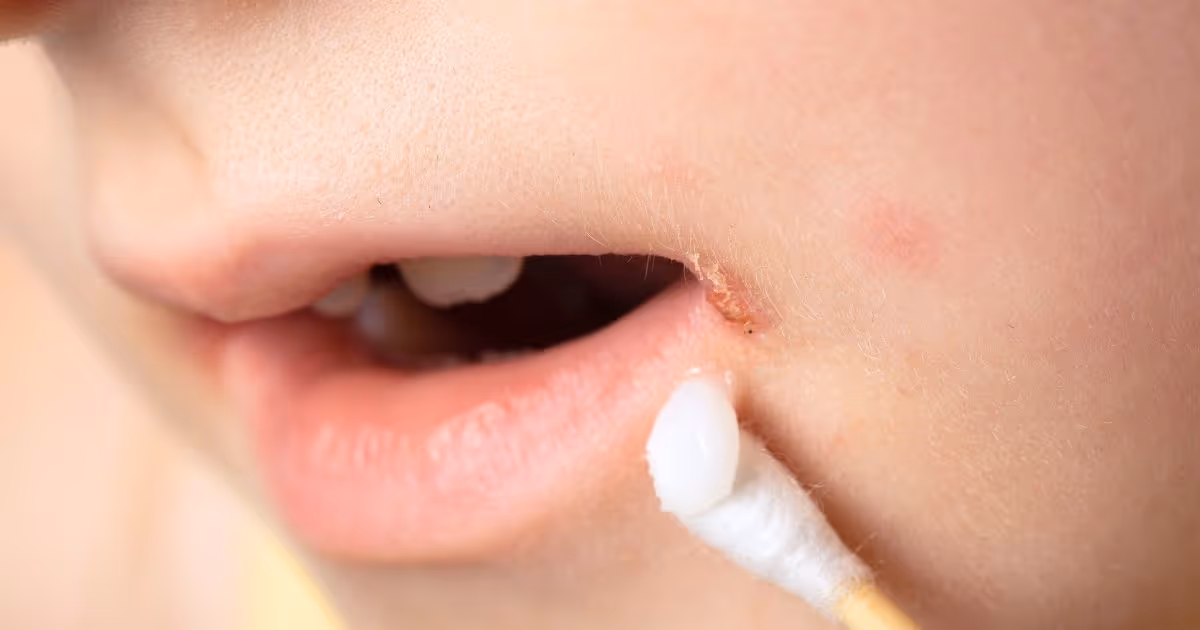 Angular Cheilitis Banner 2