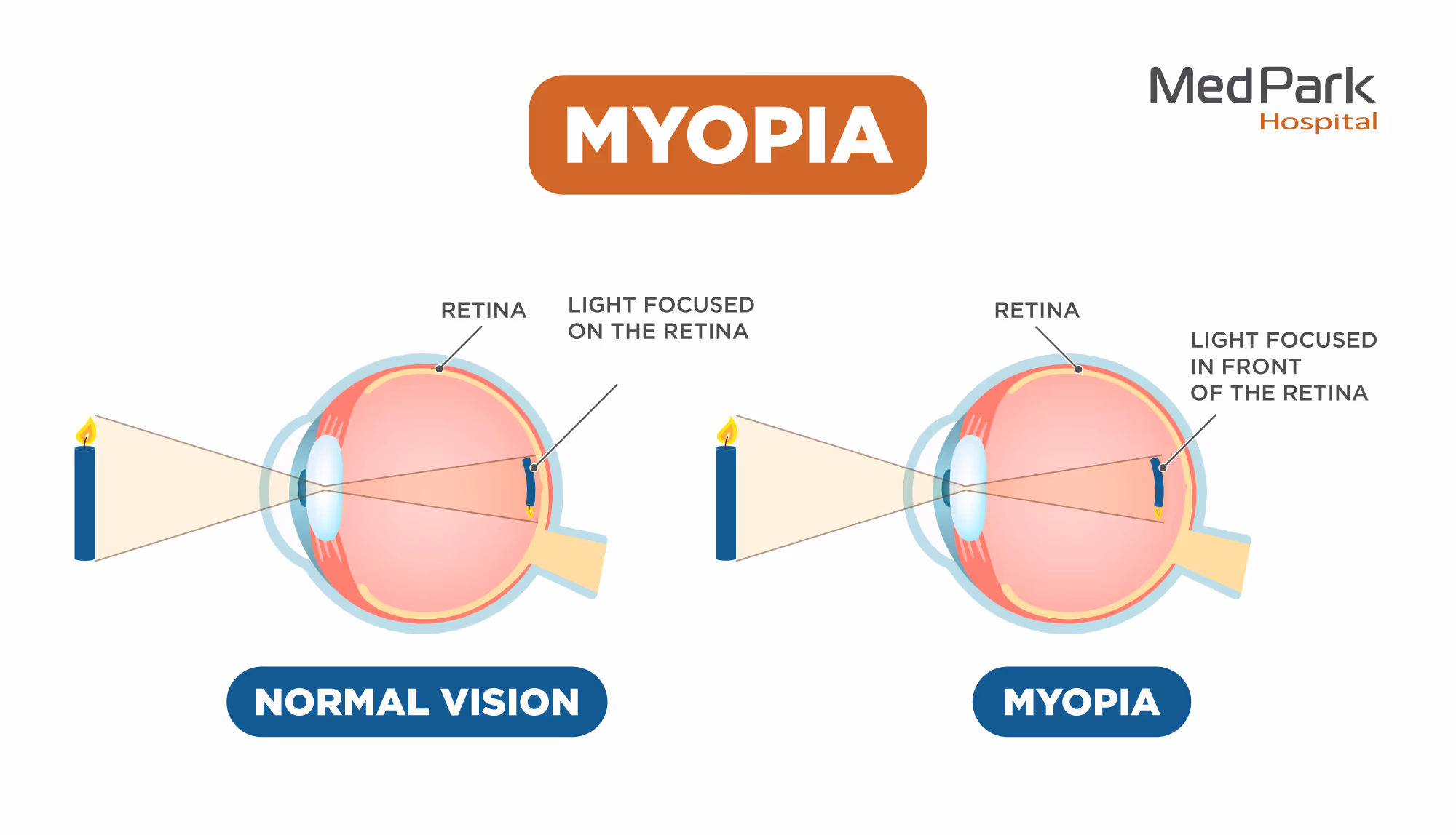 Myopia 2