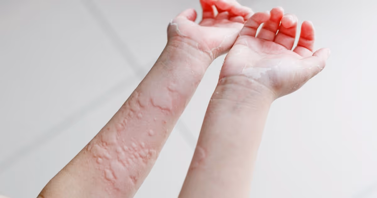 ลมพิษ มีอาการอย่างไร - What are the symptoms of urticaria (hives)?