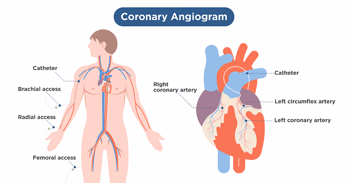 What is a coronary angiogram procedure at MedPark Hospital?