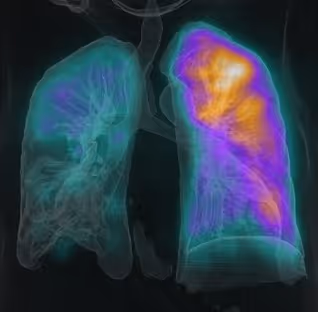 การตรวจหาภาวะอุดตันในปอด (Lung perfusion scan)
