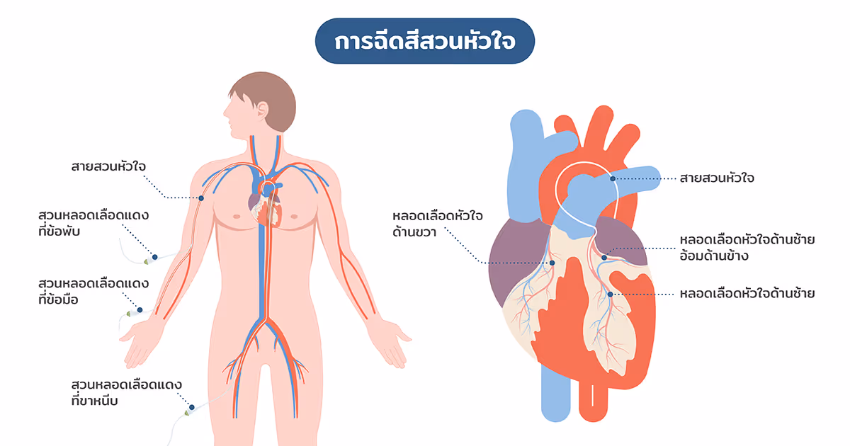 การฉีดสีสวนหัวใจ รพ.เมดพาร์คมีขั้นตอนอย่างไร?