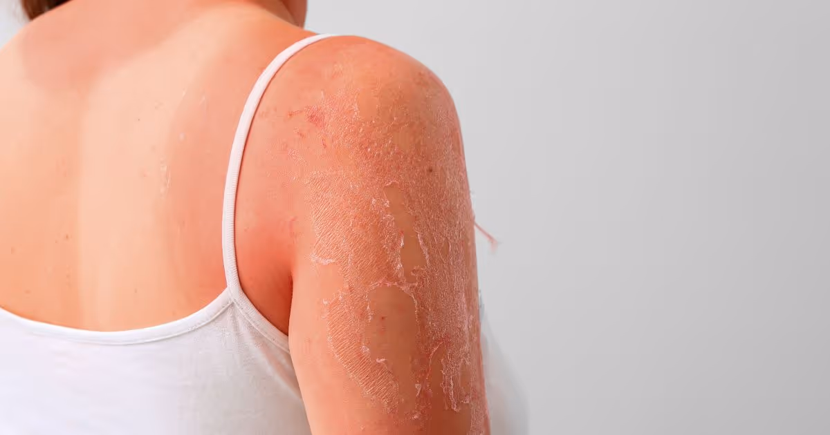 วิธีป้องกันไม่ให้ผิวไหม้ - the preventions of sunburn
