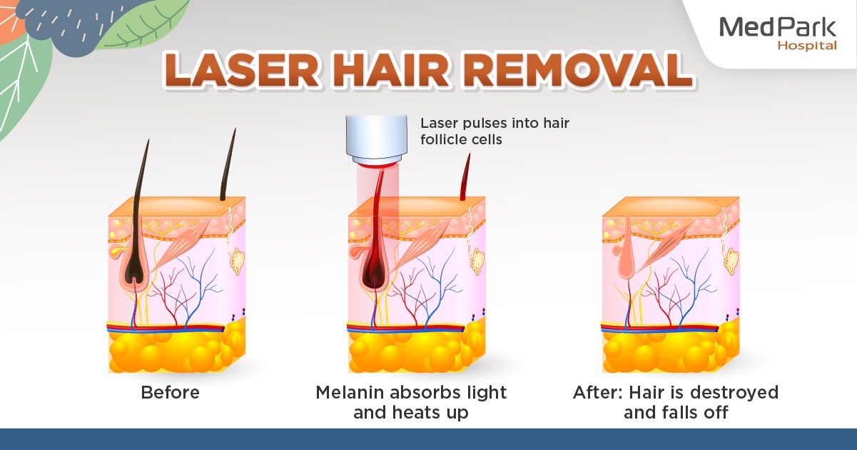 Who can have laser hair removal?