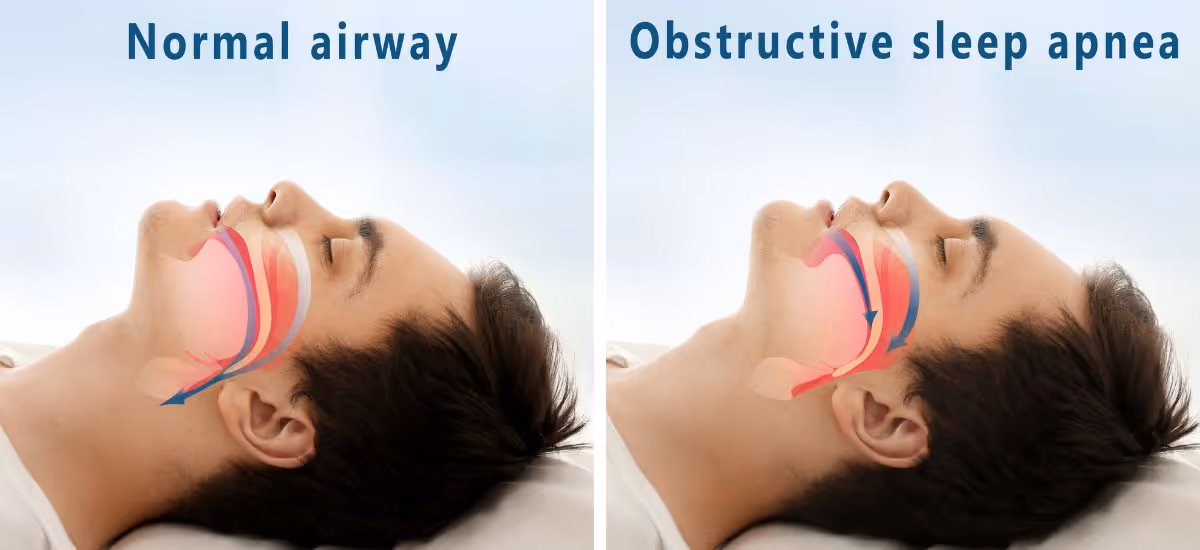 Obstructive Sleep Apnea (OSA)