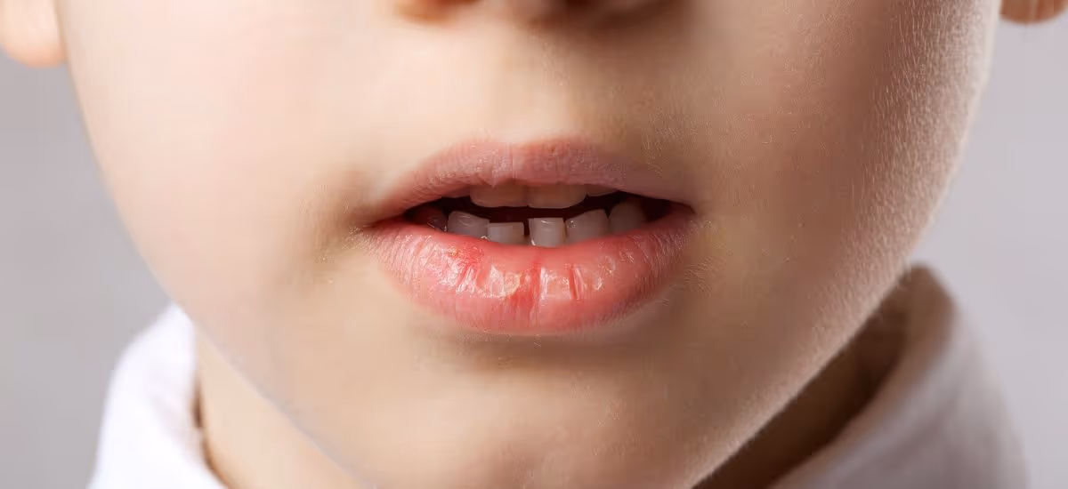 Dry Mouth Banner 2