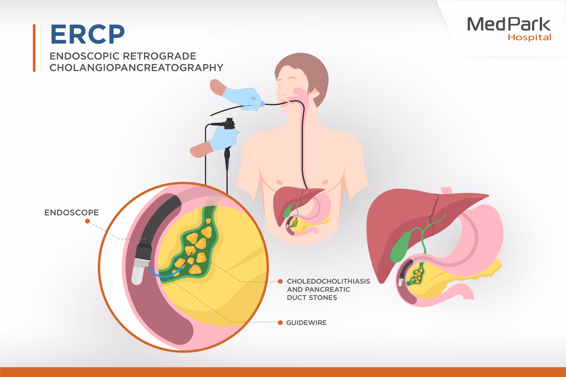 Ercp   Procedure En