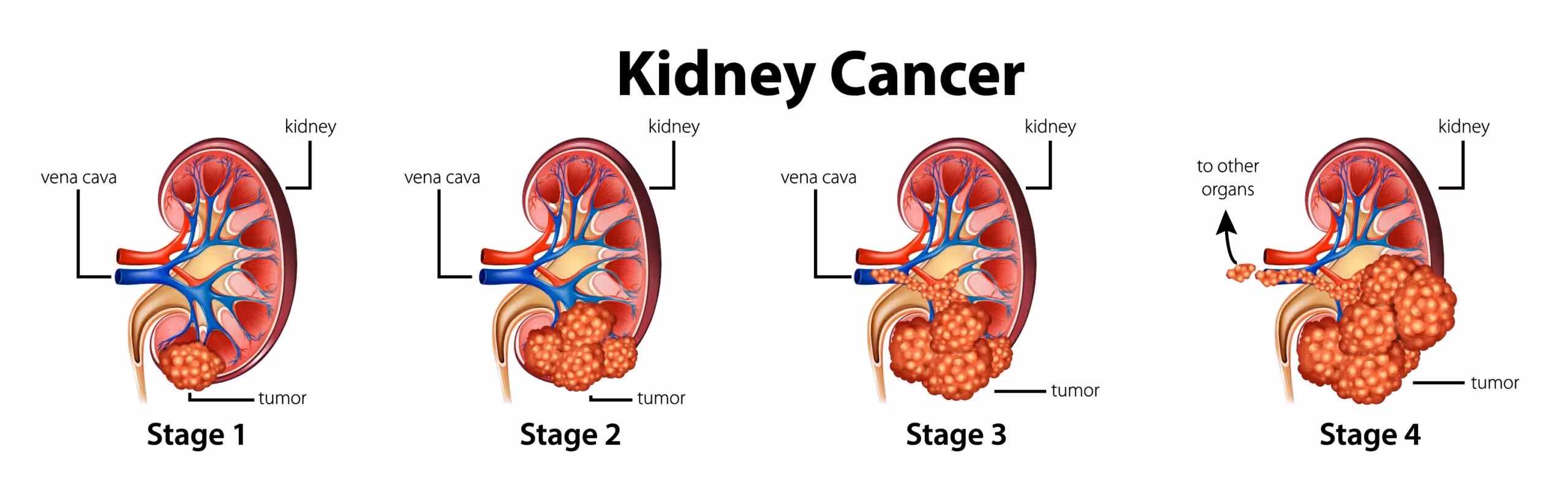 4 stages of cancer มะเร็ง 4 ระยะ